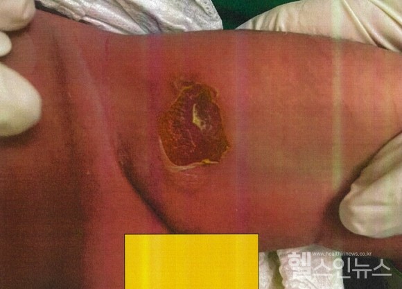 [공지] 부산 정관일 신임 기독병원 신생아실 전염성 질병(농가진) 감염 (계속 업데이트 예정) [★ 관련기사 : 6개 (뉴시스, 노답뉴스, 헬스인뉴스, KM뉴스, 국민권익신문, 굿모닝충청) ★]